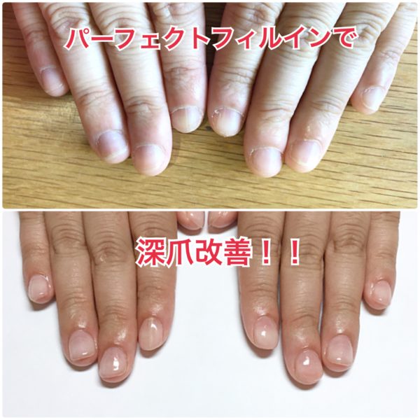 深爪矯正 深爪ラボ 名古屋市北区プライベートネイルサロン Nailroom Be 長持ちネイルパーフェクトフィルイン導入サロン